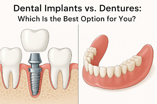 Dental Implants vs. Dentures