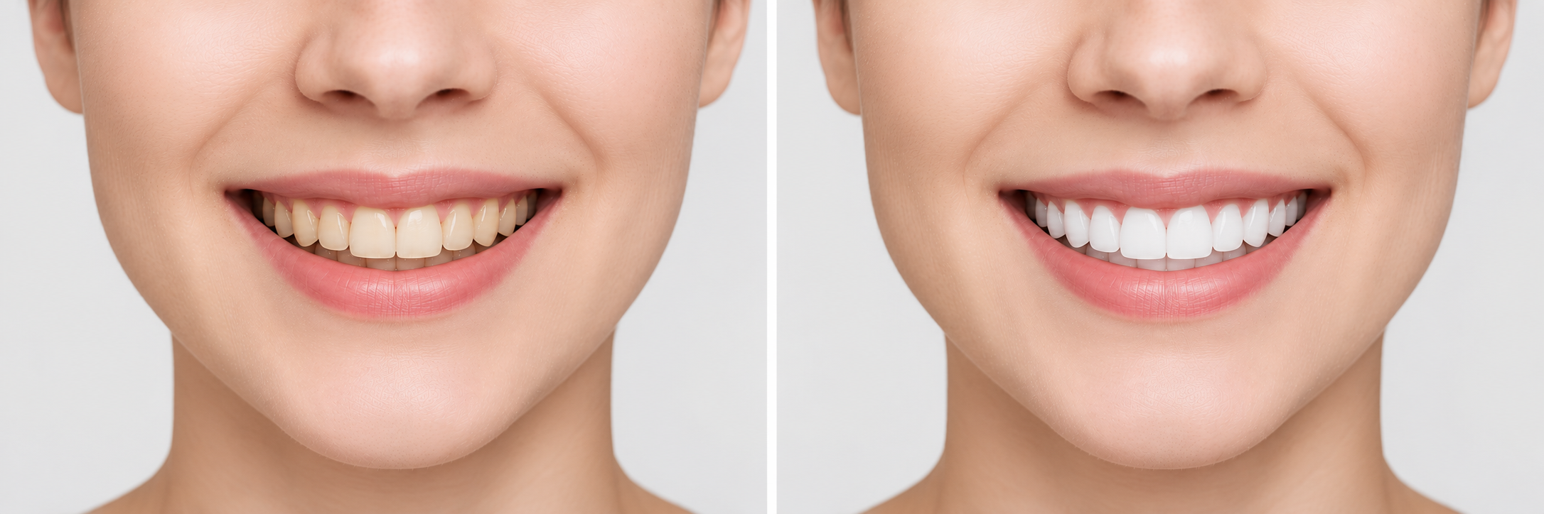 Smile Makeover Treatment