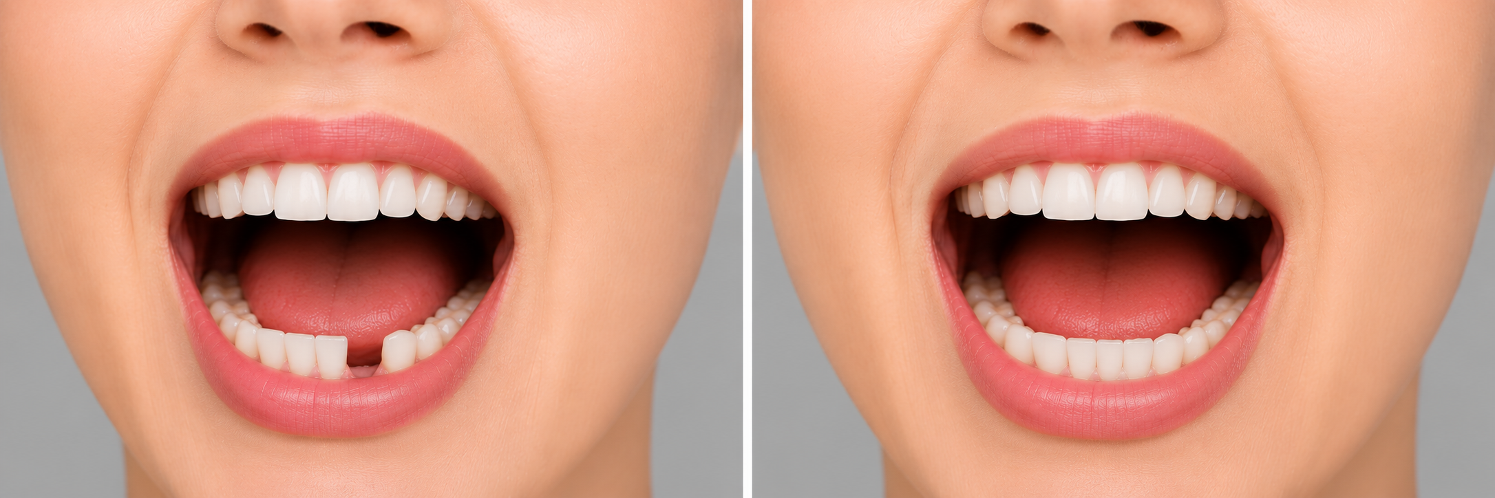 Dental Bridges Treatment