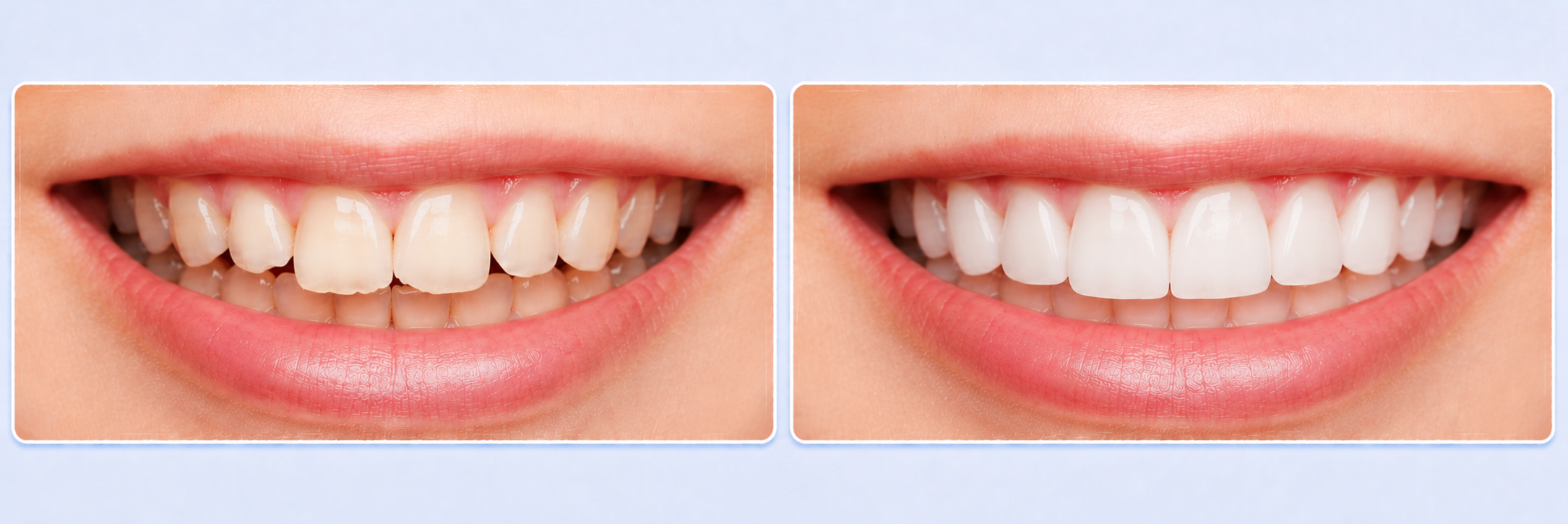Dental Veneers After before