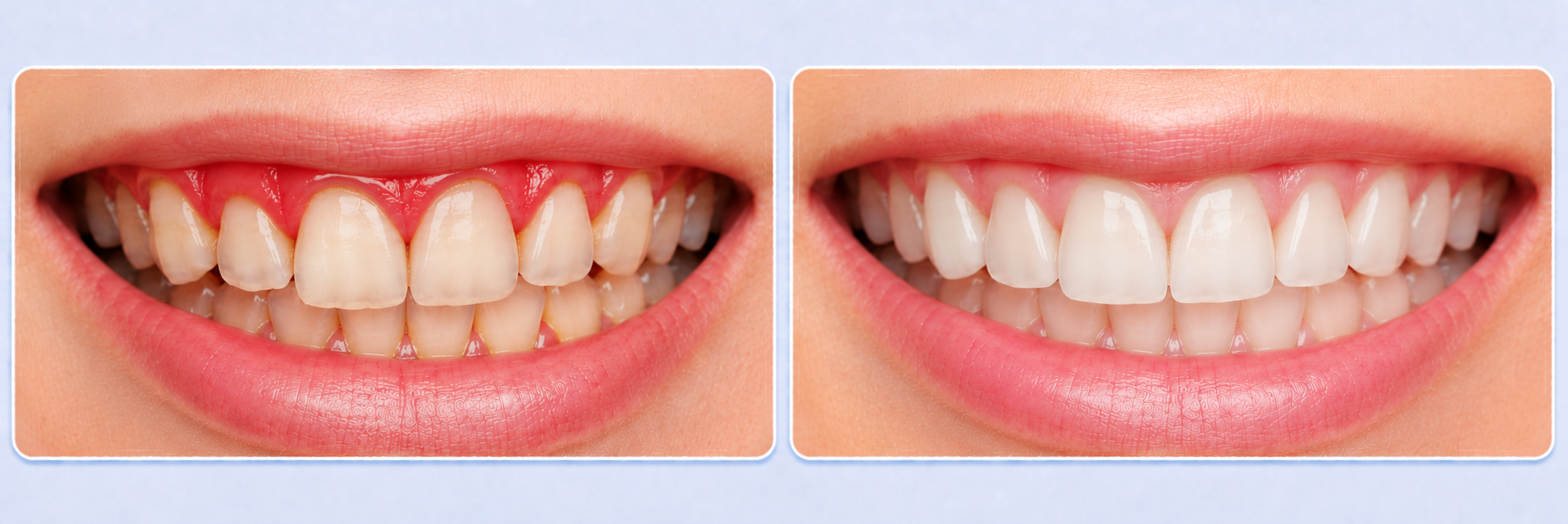 Do You Have Symptoms of Gum Disease