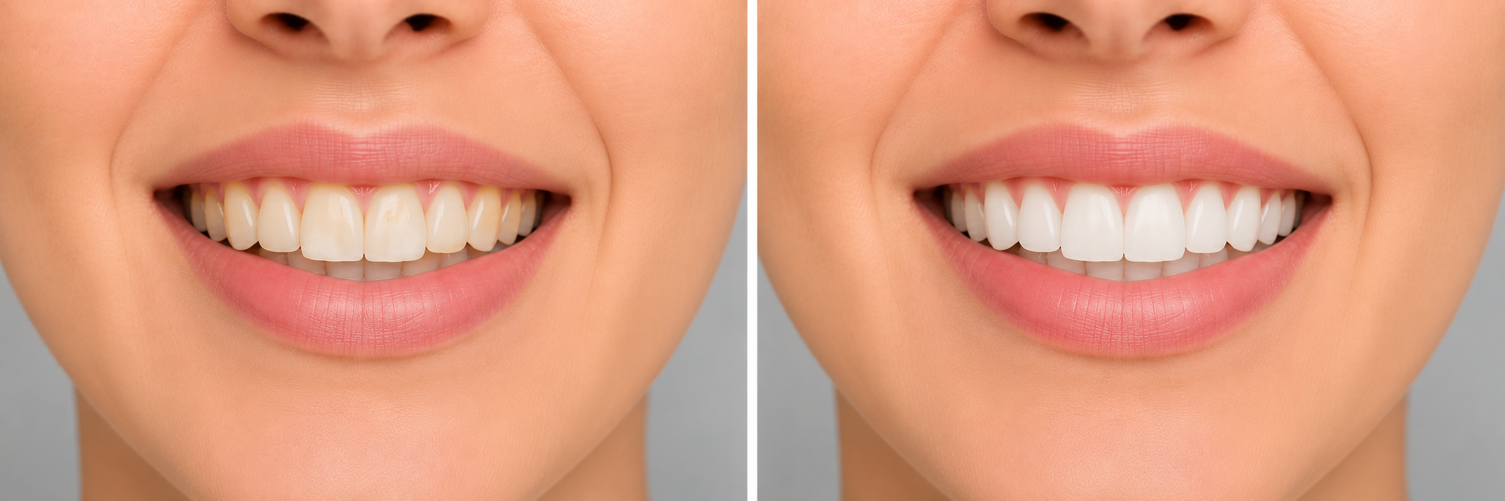 Fluoride Treatment