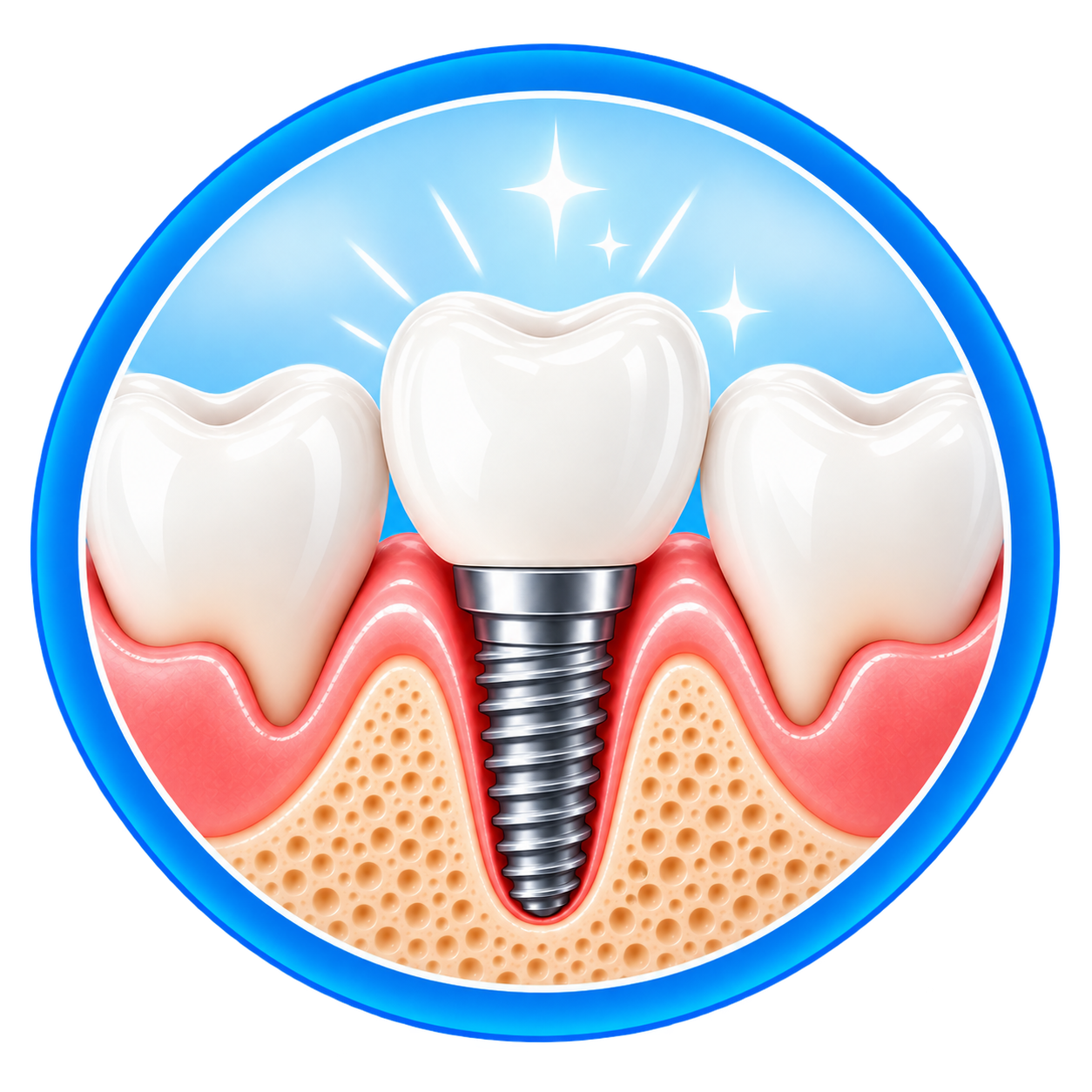 Final Implant Restoration